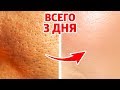 Видео - КАК НАВСЕГДА УМЕНЬШИТЬ ПОРЫ И ИЗБАВИТЬСЯ ОТ ПРЫЩЕЙ