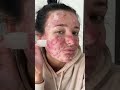 Видео - Best Fazit’s Pimple Patch Peels! #acneproneskin #acne #acnepositivity #pimplepopper #pimplepatch