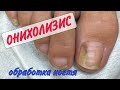 Видео - 👉🏻 ОНИХОЛИЗИС / карман под ногтем / зачистка ногтя