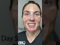 Видео - 20% TCA Chemical Peel - Wait until the end!  Results before your eyes. Melasma &amp; acne scar treatment