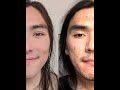 Видео - Accutane Transformation Timelapse #shorts