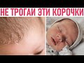 Видео - МОЛОЧНЫЕ КОРОЧКИ | Вот почему нельзя трогать молочные корочки у малыша