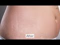 Видео - Stretch Mark Removal Cream| Fixderma- Strallium Stretch Marks Cream