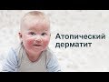 Видео - Атопический  дерматит : Аллерголог, Иммунолог Парвиз Азизов