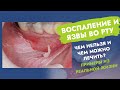 Видео - Воспаление во рту. Язвы во рту. Чем нельзя и чем можно лечить?