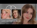 Видео - ДВАЖДЫ ПОБЕДИЛА АКНЕ / Моя история лечения и ухода / МНОГО ФОТО