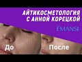 Видео - Уход за кожей вокруг глаз. Патчи Emansi. До/После