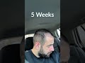 Видео - Hair Transplant Process - Week by Week - 3 Months