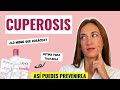 Видео - ⏩ ¿Qué es la CUPEROSIS? ¿Cómo se TRATA? 🤔 + PRODUCTOS que RECOMIENDO ✅⚡