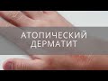 Видео - #Атопический дерматит.Уход за #кожей, мази,правила жизни с сыпью у детей.