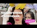 Видео - АНДРОГЕННАЯ АЛОПЕЦИЯ как с ней бороться? Выпадают волосы, PRP, мезотерапия, витамины, миноксидил