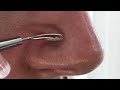 Видео - Салфетки для удаления черных точек/CIRACLE Pore Control BLACKHEAD OFF SHEET