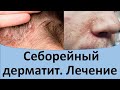 Видео - Себорейный дерматит лечение.