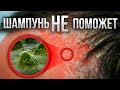 Видео - ЖИРНАЯ СЕБОРЕЯ КОЖИ ГОЛОВЫ: причины и лечение за 5 шагов