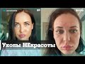 Видео - Жительница Перми постарела на 15 лет после уколов красоты