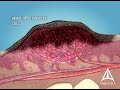 Видео - What are warts (HPV)? - 3D animation