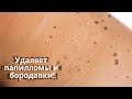 Видео - Дешевые средства ОТ ПАПИЛЛОМ и БОРОДАВОК! Безопасно и просто удалить папилломы и удалить бородавки.