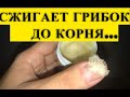 Видео - Эта ЯДРЕНАЯ Мазь, Съедает Ногтевой Грибок До Самого Корня! Есть в Любой Аптеке..