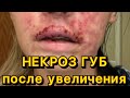 Видео - К чему приводит недостаток знаний у косметолога. Некроз при инъекции филлера в губы для увеличения