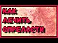 Видео - ИЗБАВЛЯЕМСЯ от опрелостей за 1 день!