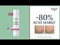 Видео - NEW! -80% acne marks with Eucerin Triple Effect Serum