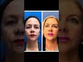 Видео - Reno/Tahoe Morpheus+CO2 Laser Healing from Skin Tightening and Resurfacing | Dr. Erez Dayan