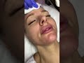 Видео - Ультразвуковая чистка лица ☺️#zaffiroclinic