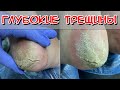 Видео - Глубокие трещины / #Кератоз / #Глубокий кератоз / Первый визит / Подология #педикюр