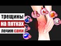 Видео - Трещины на пятках – что они скрывают и что делать в домашних условиях