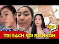 Видео - TRỊ SẠCH SỢI BÃ NHỜN [ tập 1 ] Cương và tấn công sợi bã nhờn đúng lúc &amp; hiệu ❗