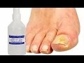 Видео - Как лечить грибок  ногтей перекисью водорода