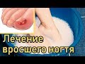 Видео - Вросший Ноготь Лечение в домашних условиях [Как избавиться от вросшего ногтя без операции]