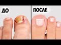 Видео - Лечение вросшего ногтя ✅5 способов удалить вросший ноготь в домашних условиях