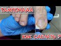 Видео - Как сделать тампонаду / Тампонада вросшего ногтя / Как поставить тампонаду
