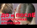 Видео - Женское облысение. Андрогенная алопеция. Как востановить красивые волосы