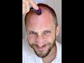 Видео - How I Use DermaRoller for Hair Growth and To Solve my Baldness and Hair Loss Tutorial 4k