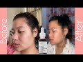 Видео - The Ordinary AHA 30% &amp; BHA 2% Peeling Solution 3 months result