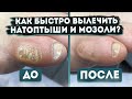 Видео - Как мгновенно избавиться от мозолей и натоптышей? | Мнение подолога | Лечение | Диагностика | MEDPED