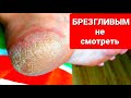 Видео - Как быстро удалить мозоли и натоптыши 👣 Очень простой способ Глубокие  трещины на пятках