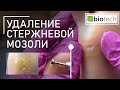 Видео - УДАЛЕНИЕ СТЕРЖНЕВОЙ МОЗОЛИ/ИСПОЛЬЗОВАНИЕ КЕРАТОЛИТИКА ПРИ УДАЛЕНИИ МОЗОЛЕЙ