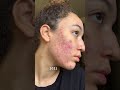 Видео - 2 Year Tretinoin Transformation | Arianna India #shorts #skincare #retinol #tretinoin #beyonce